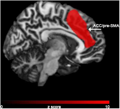 Role of the Cingulate Cortex in Dyskinesias-Reduced-Self-Awareness: An fMRI Study on Parkinson’s Disease Patients